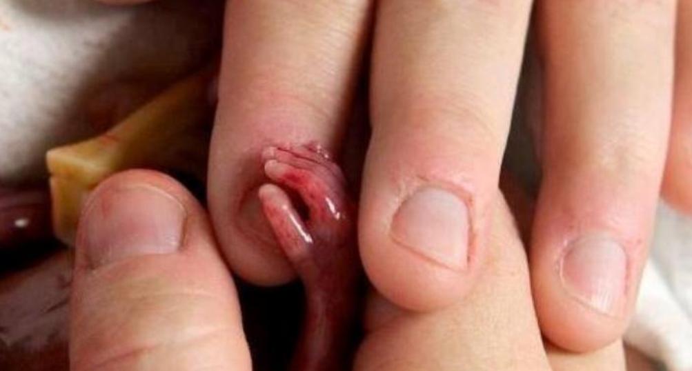 Milano| Nel mondo oltre 43mila donne muoiono per aborto non sicuro