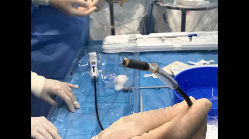 Benevento| Intervento cardiaco senza incisioni