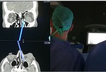 Benevento| Al “San Pio” eseguito intervento di asportazione di tumore all’occhio attraverso le fosse nasali