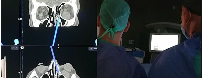 Benevento| Al “San Pio” eseguito intervento di asportazione di tumore all’occhio attraverso le fosse nasali