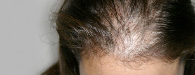 Riaperti i termini dell’avviso per l’acquisto di parrucche per  le donne con alopecia da chemioterapia