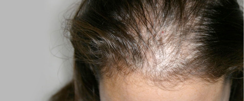 Riaperti i termini dell’avviso per l’acquisto di parrucche per  le donne con alopecia da chemioterapia
