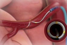 Cardiologia all’ospedale Fatebenefratelli, venerdi 16 aprile un convegno webinar