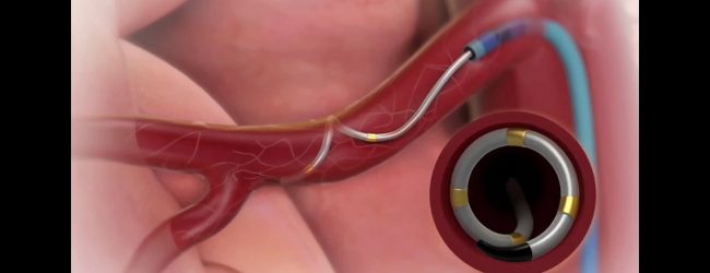 Cardiologia all’ospedale Fatebenefratelli, venerdi 16 aprile un convegno webinar