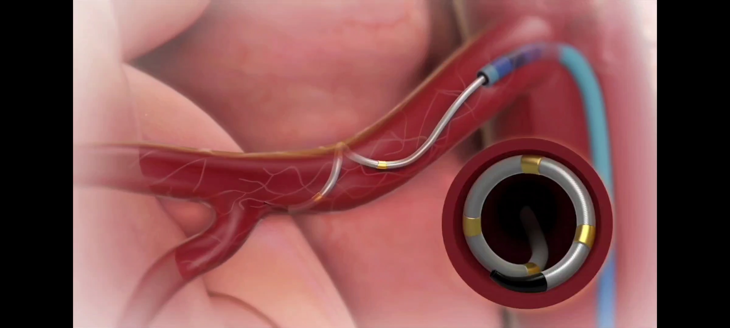 Cardiologia all’ospedale Fatebenefratelli, venerdi 16 aprile un convegno webinar