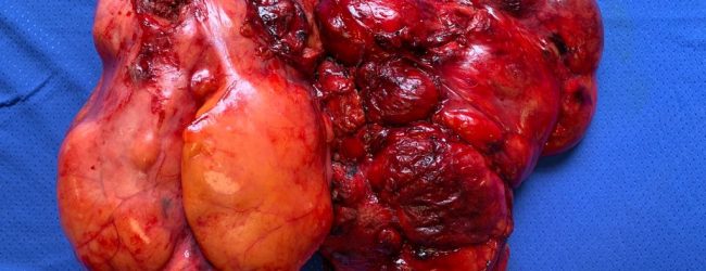 Moscati, asportato liposarcoma di 4 chili: eccezionale intervento chirurgico in collaborazione con il Monaldi