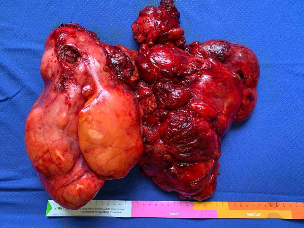 Moscati, asportato liposarcoma di 4 chili: eccezionale intervento chirurgico in collaborazione con il Monaldi