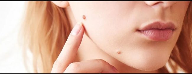 Tele-dermatologia, continua con successo il progetto “Clicca il Neo” promosso dalla LILT Benevento