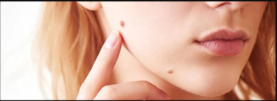 Tele-dermatologia, continua con successo il progetto “Clicca il Neo” promosso dalla LILT Benevento