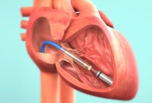 Al Fatebenefratelli di Benevento il primo pacemaker bicamerale invisibile
