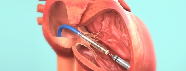 Al Fatebenefratelli di Benevento il primo pacemaker bicamerale invisibile