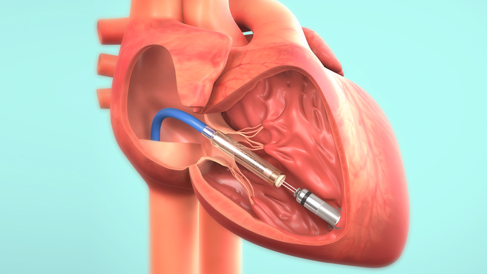 Al Fatebenefratelli di Benevento il primo pacemaker bicamerale invisibile