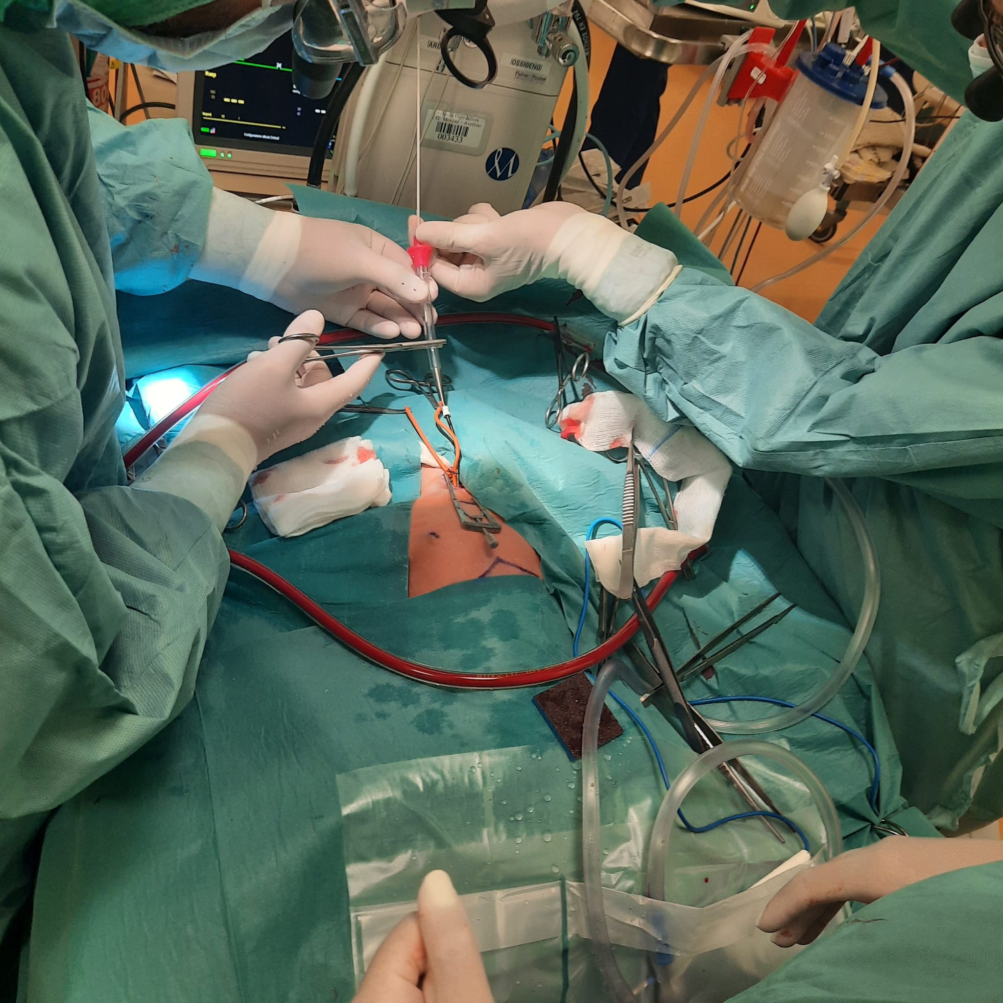 Sinergia tra specialisti salva la vita a neonato di Caserta, stabilizzato al Moscati e trasferito al Bambin Gesù