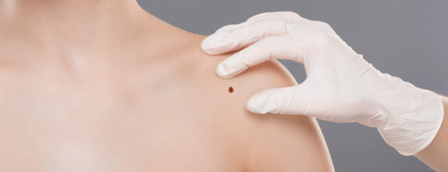 Lions Club Benevento: da venerdi 26 Maggio a mercoledi 31 Maggio visite gratuite per prevenzione tumori cutanei