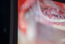 Nevralgia del trigemino, al “San Pio” intervento microchirurgico per il trattamento del dolore