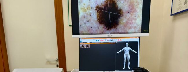 Aorn “San Pio”, introdotti il videodermatoscopio e la cabina di fototerapia