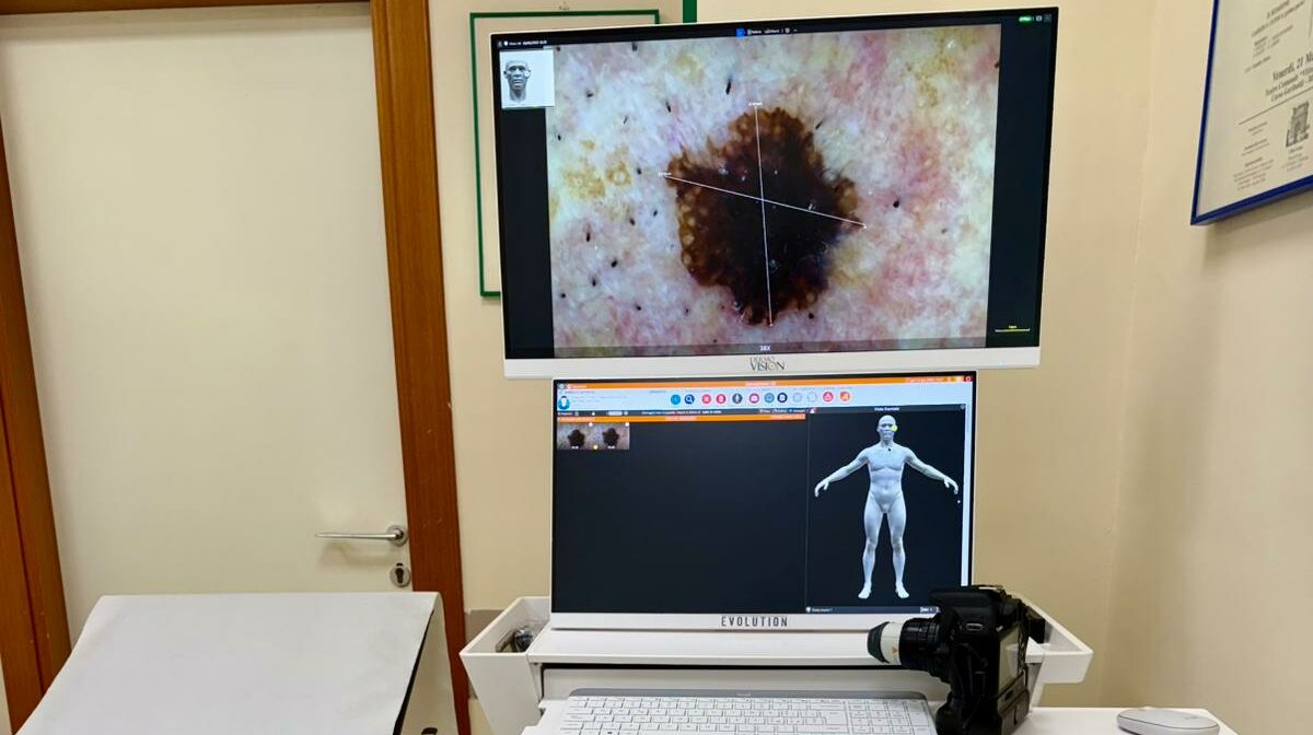 Aorn “San Pio”, introdotti il videodermatoscopio e la cabina di fototerapia