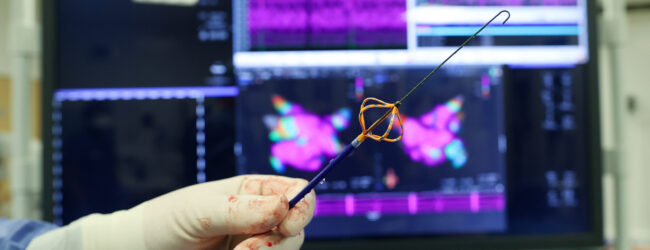 Fibrillazione atriale, prime ablazioni a campo pulsato al Fatebenefratelli di Benevento