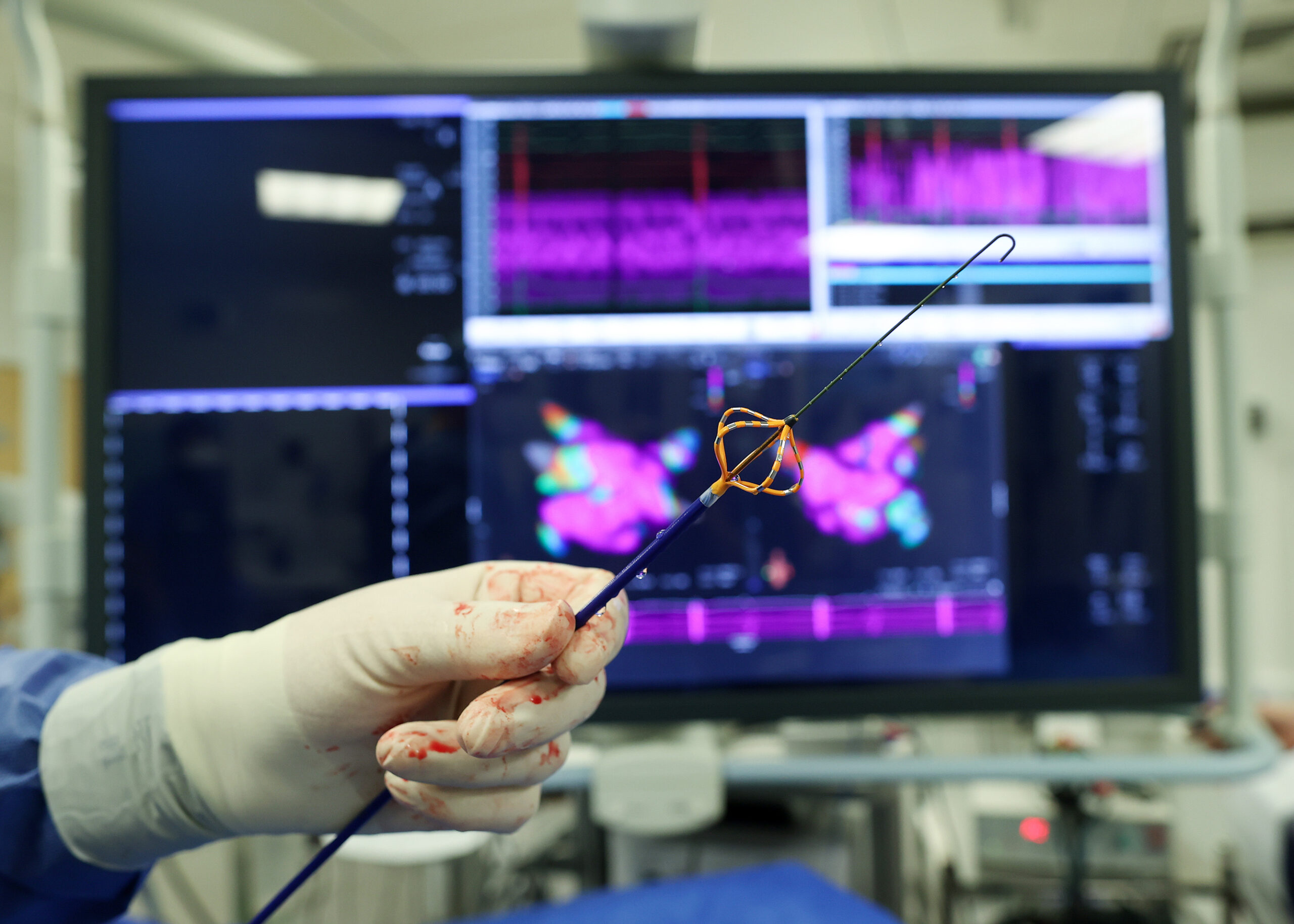 Fibrillazione atriale, prime ablazioni a campo pulsato al Fatebenefratelli di Benevento