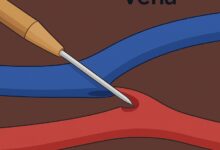 Sanità, al Moscati di Avellino dialisi senza bisturi: primi interventi in Campania