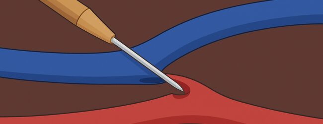 Sanità, al Moscati di Avellino dialisi senza bisturi: primi interventi in Campania