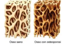 Prevenire le fratture e proteggere la salute delle ossa:  il 20 ottobre Moc e visite gratuite al plesso ospedaliero Landolfi di Solofra