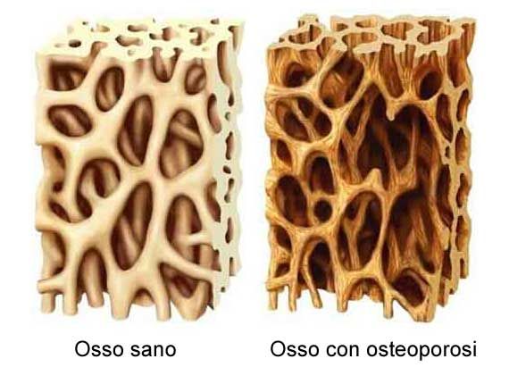 Prevenire le fratture e proteggere la salute delle ossa:  il 20 ottobre Moc e visite gratuite al plesso ospedaliero Landolfi di Solofra