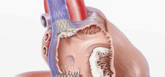 Al Fatebenefratelli “impianto percutaneo di valvola tricuspide”, la prima volta a Benevento e tra le prime nell’Italia meridionale