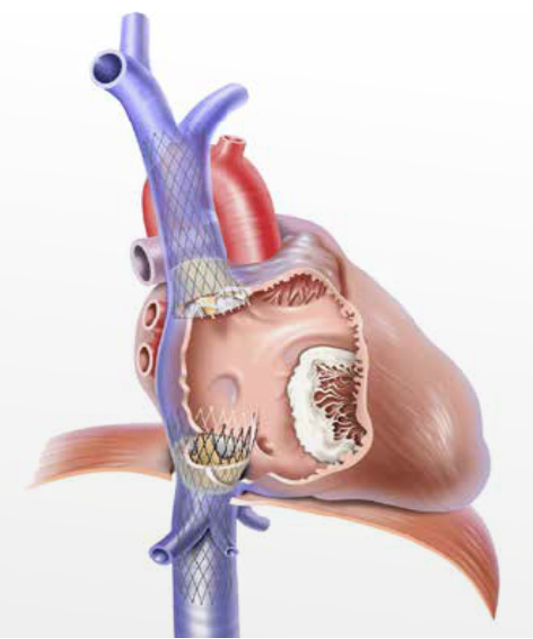 Al Fatebenefratelli “impianto percutaneo di valvola tricuspide”, la prima volta a Benevento e tra le prime nell’Italia meridionale