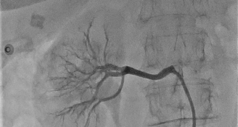 Denervazione percutanea delle arterie renali, al Fatebenefratelli di Benevento da oggi anche con ultrasuoni