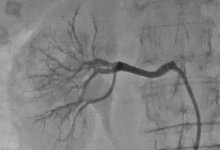 Denervazione percutanea delle arterie renali, al Fatebenefratelli di Benevento da oggi anche con ultrasuoni