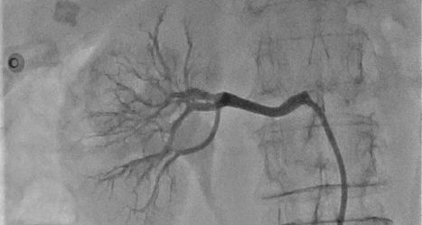 Denervazione percutanea delle arterie renali, al Fatebenefratelli di Benevento da oggi anche con ultrasuoni